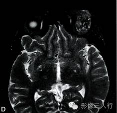 【病例】泪腺黏液表皮样癌1例MR影像表现分析 【病例】泪腺黏液表皮样癌1例MR影像表现分析