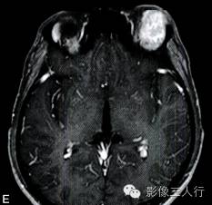 【病例】泪腺黏液表皮样癌1例MR影像表现分析 【病例】泪腺黏液表皮样癌1例MR影像表现分析