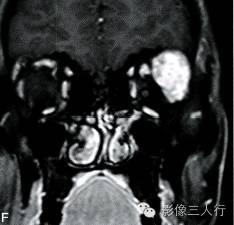 【病例】泪腺黏液表皮样癌1例MR影像表现分析 【病例】泪腺黏液表皮样癌1例MR影像表现分析
