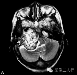 【病例】颈静脉球瘤1例MR影像表现