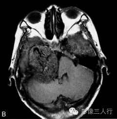 【病例】颈静脉球瘤1例MR影像表现 【病例】颈静脉球瘤1例MR影像表现