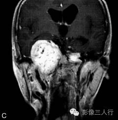 【病例】颈静脉球瘤1例MR影像表现 【病例】颈静脉球瘤1例MR影像表现