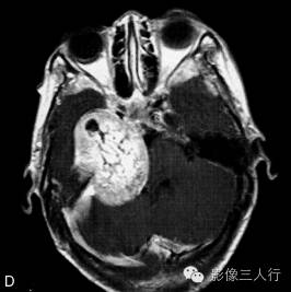 【病例】颈静脉球瘤1例MR影像表现 【病例】颈静脉球瘤1例MR影像表现
