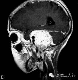 【病例】颈静脉球瘤1例MR影像表现 【病例】颈静脉球瘤1例MR影像表现
