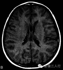 【病例】结节性硬化伴胶质母细胞瘤1例MR影像表现分析 【病例】结节性硬化伴胶质母细胞瘤1例MR影像表现分析