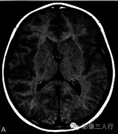 【病例】结节性硬化伴胶质母细胞瘤1例MR影像表现分析 【病例】结节性硬化伴胶质母细胞瘤1例MR影像表现分析