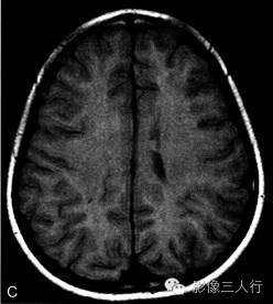 【病例】结节性硬化伴胶质母细胞瘤1例MR影像表现分析 【病例】结节性硬化伴胶质母细胞瘤1例MR影像表现分析