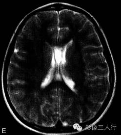 【病例】结节性硬化伴胶质母细胞瘤1例MR影像表现分析 【病例】结节性硬化伴胶质母细胞瘤1例MR影像表现分析