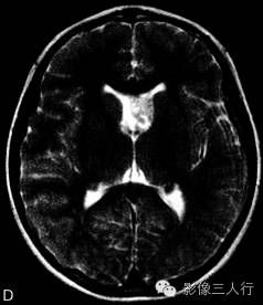 【病例】结节性硬化伴胶质母细胞瘤1例MR影像表现分析