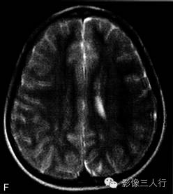 【病例】结节性硬化伴胶质母细胞瘤1例MR影像表现分析 【病例】结节性硬化伴胶质母细胞瘤1例MR影像表现分析
