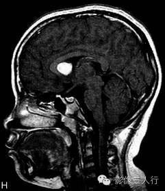 【病例】结节性硬化伴胶质母细胞瘤1例MR影像表现分析 【病例】结节性硬化伴胶质母细胞瘤1例MR影像表现分析