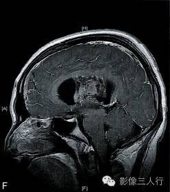 【病例】室管膜下巨细胞型星形细胞瘤1例MR影像表现分析 【病例】室管膜下巨细胞型星形细胞瘤1例MR影像表现分析