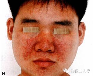 【病例】室管膜下巨细胞型星形细胞瘤1例MR影像表现分析 【病例】室管膜下巨细胞型星形细胞瘤1例MR影像表现分析