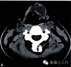 【病例】甲状舌管囊肿1例CT影像表现 【病例】甲状舌管囊肿1例CT影像表现