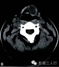 【病例】甲状舌管囊肿1例CT影像表现 【病例】甲状舌管囊肿1例CT影像表现