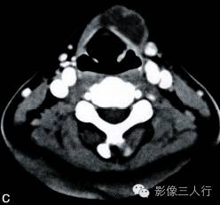 【病例】甲状舌管囊肿1例CT影像表现 【病例】甲状舌管囊肿1例CT影像表现