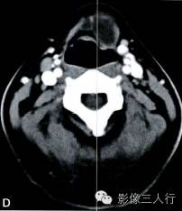 【病例】甲状舌管囊肿1例CT影像表现 【病例】甲状舌管囊肿1例CT影像表现