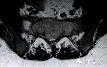 【病例】骶椎骨巨细胞瘤1例MR影像表现分析
