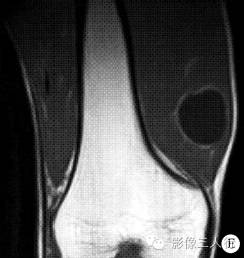 【病例】右膝关节旁股四头肌内腱鞘囊肿1例MR影像表现 【病例】右膝关节旁股四头肌内腱鞘囊肿1例MR影像表现