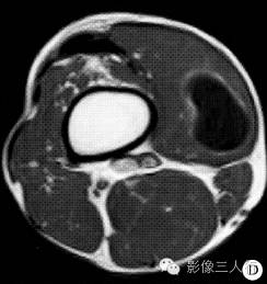 【病例】右膝关节旁股四头肌内腱鞘囊肿1例MR影像表现
