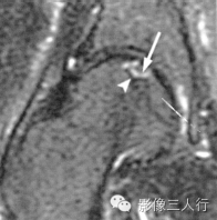 "双线征"，这个征象提示啥？