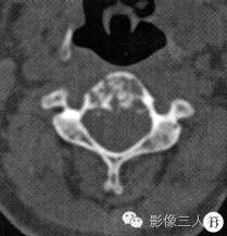 【病例】颈3椎体脊索瘤1例CT及MR影像表现