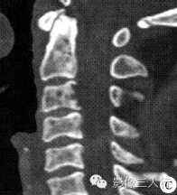 【病例】颈3椎体脊索瘤1例CT及MR影像表现