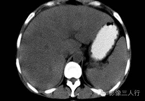 【病例】肝小静脉闭塞症1例CT影像表现分析