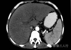 【病例】肝小静脉闭塞症1例CT影像表现分析 【病例】肝小静脉闭塞症1例CT影像表现分析