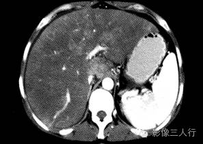 【病例】肝小静脉闭塞症1例CT影像表现分析 【病例】肝小静脉闭塞症1例CT影像表现分析