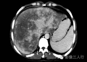 【病例】肝小静脉闭塞症1例CT影像表现分析 【病例】肝小静脉闭塞症1例CT影像表现分析