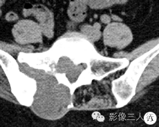 【病例】右骶髂软骨肉瘤1例CT及MR影像表现分析