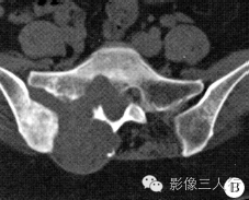 【病例】右骶髂软骨肉瘤1例CT及MR影像表现分析 【病例】右骶髂软骨肉瘤1例CT及MR影像表现分析