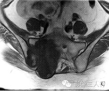 【病例】右骶髂软骨肉瘤1例CT及MR影像表现分析 【病例】右骶髂软骨肉瘤1例CT及MR影像表现分析