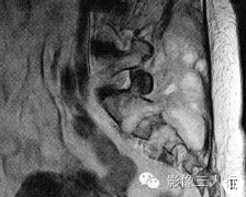 【病例】右骶髂软骨肉瘤1例CT及MR影像表现分析 【病例】右骶髂软骨肉瘤1例CT及MR影像表现分析
