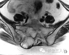 【病例】右骶髂软骨肉瘤1例CT及MR影像表现分析 【病例】右骶髂软骨肉瘤1例CT及MR影像表现分析