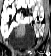 【病例】脐尿管癌1例CT影像表现 【病例】脐尿管癌1例CT影像表现