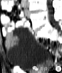 【病例】脐尿管癌1例CT影像表现 【病例】脐尿管癌1例CT影像表现