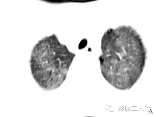 【病例】两肺特发性含铁血黄素沉着症1例CT影像分析 【病例】两肺特发性含铁血黄素沉着症1例CT影像分析