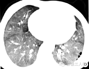 【病例】两肺特发性含铁血黄素沉着症1例CT影像分析 【病例】两肺特发性含铁血黄素沉着症1例CT影像分析