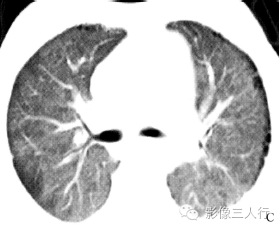 【病例】两肺特发性含铁血黄素沉着症1例CT影像分析 【病例】两肺特发性含铁血黄素沉着症1例CT影像分析