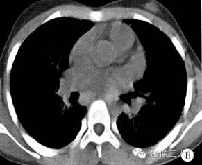 【病例】两肺特发性含铁血黄素沉着症1例CT影像分析 【病例】两肺特发性含铁血黄素沉着症1例CT影像分析