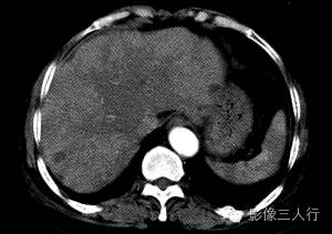 【病例】肝小静脉闭塞症1例CT影像表现分析