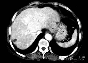 【病例】肝小静脉闭塞症1例CT影像表现分析