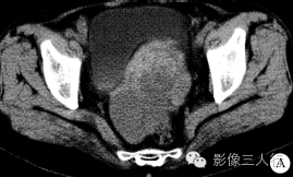 【病例】盆底小肠间质肉瘤1例CT影像表现