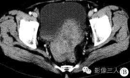 【病例】盆底小肠间质肉瘤1例CT影像表现 【病例】盆底小肠间质肉瘤1例CT影像表现