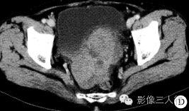 【病例】盆底小肠间质肉瘤1例CT影像表现 【病例】盆底小肠间质肉瘤1例CT影像表现