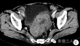 【病例】盆底小肠间质肉瘤1例CT影像表现 【病例】盆底小肠间质肉瘤1例CT影像表现