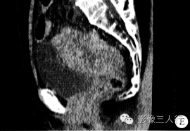 【病例】盆底小肠间质肉瘤1例CT影像表现 【病例】盆底小肠间质肉瘤1例CT影像表现