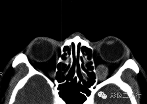 【病例】甲状腺相关性眼病1例CT影像表现分析 【病例】甲状腺相关性眼病1例CT影像表现分析